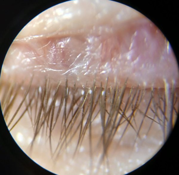 The same lash line, clean, after an in-clinic lid clean