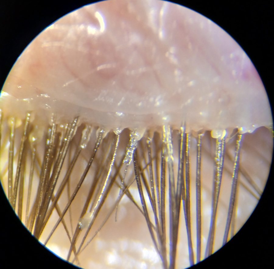 Eyelid margin before treatment: blocked gland openings and debris at the lash base