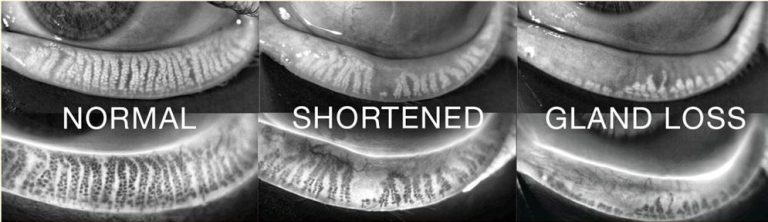 Infrared photographs of eyelid oil glands: normal, shortened and gland loss