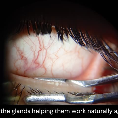 Blocked: oil has set inside the glands